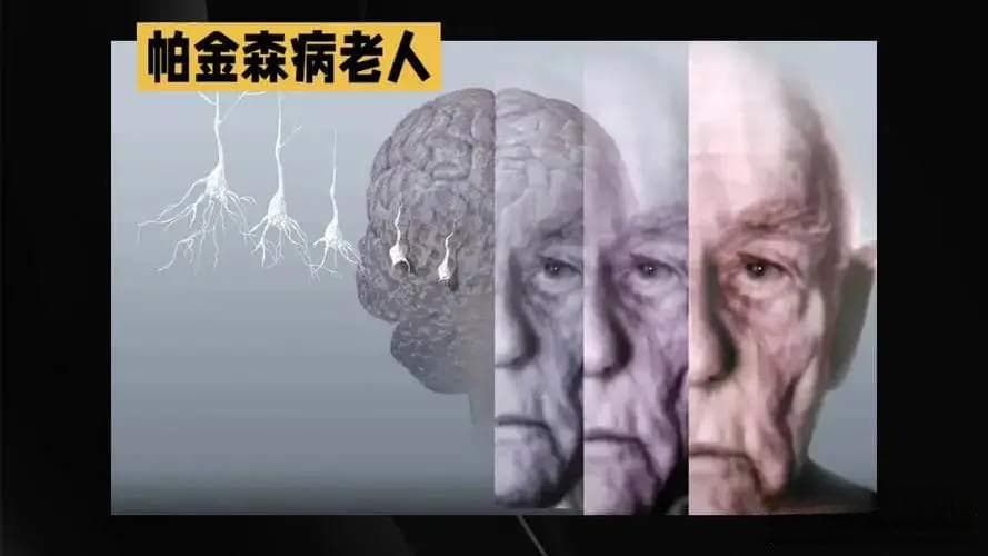 帕金森病：解密环境、遗传与生活方式的交织，揭示病因与建议