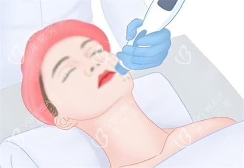 热玛吉和热拉提哪个好？多角度揭秘二者区别~看完你就知道怎么选择