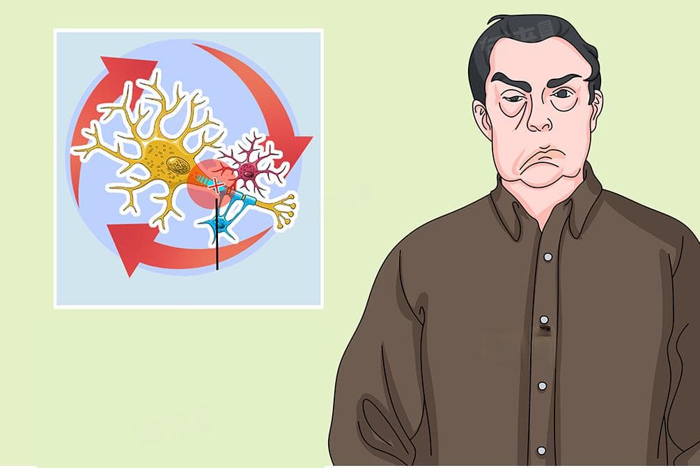 吉兰-巴雷综合征的临床表现及治疗方法