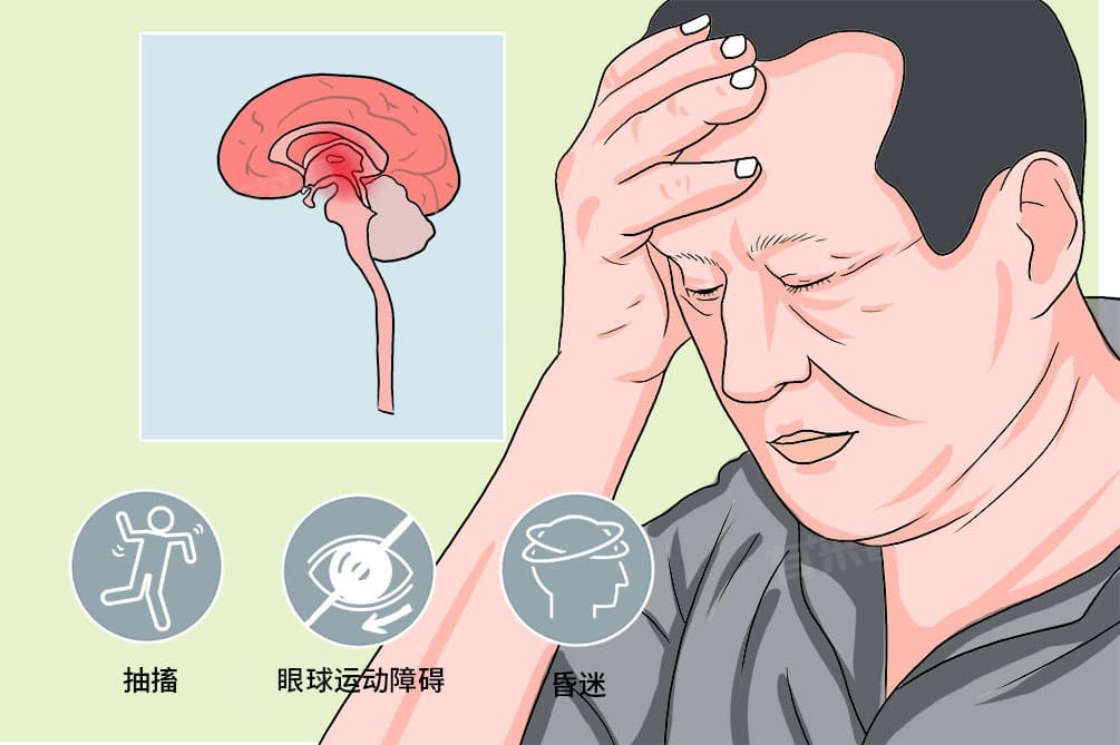 脑干出血前兆的6个表现