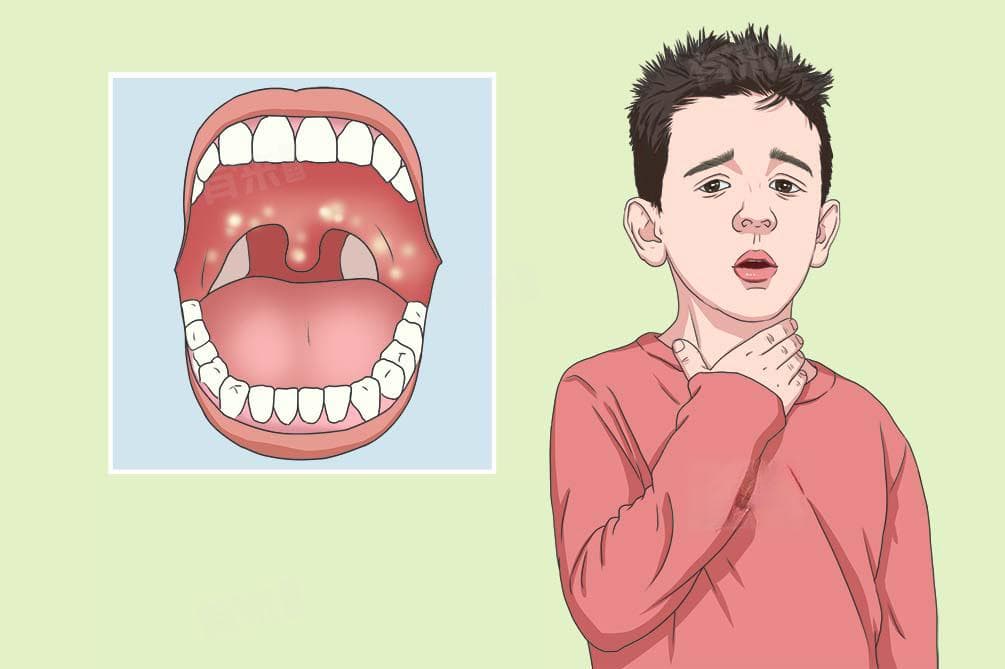 嗓子发炎有白色脓点怎么办？原因、治疗与预后全解析