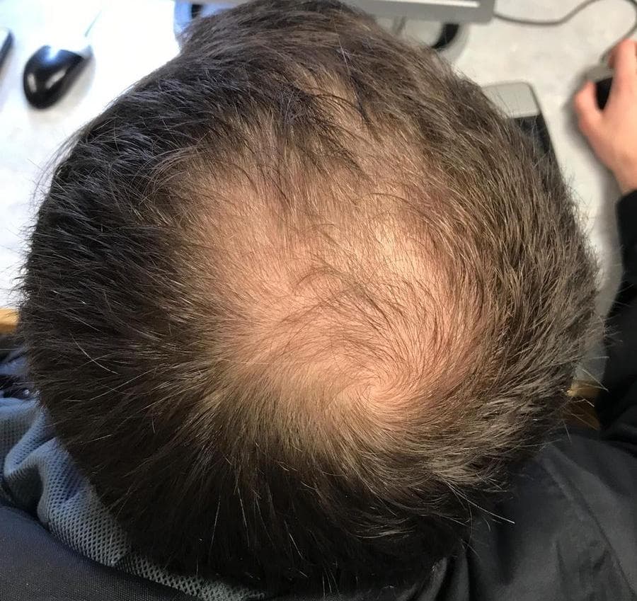 缓解全球近 50% 男性秃头困扰，2dDR 天然糖被发现：成本低、疗效稳定