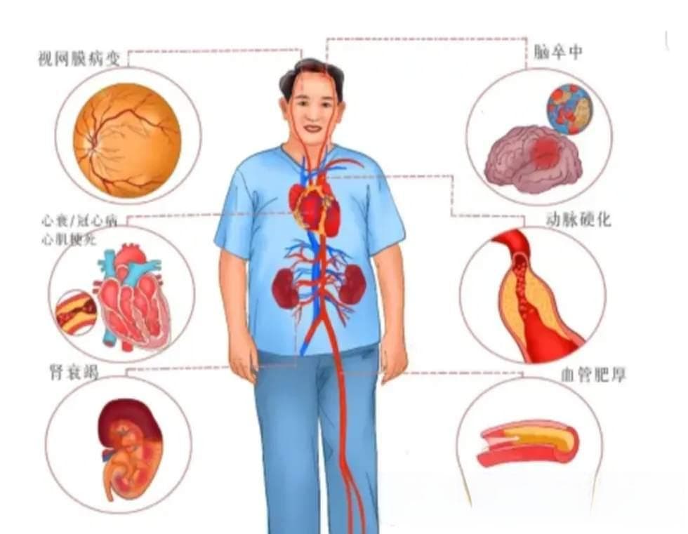 脂蛋白a升高——容易被忽视的血脂指标