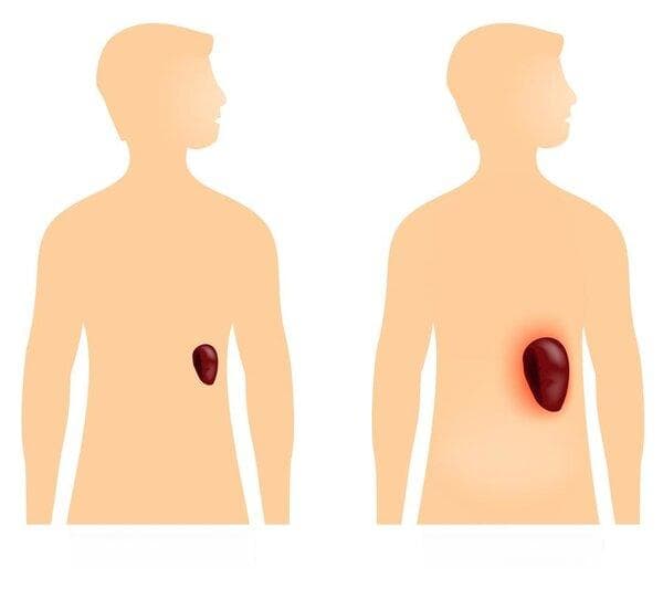 怎么辨别肝腹水和腹水
