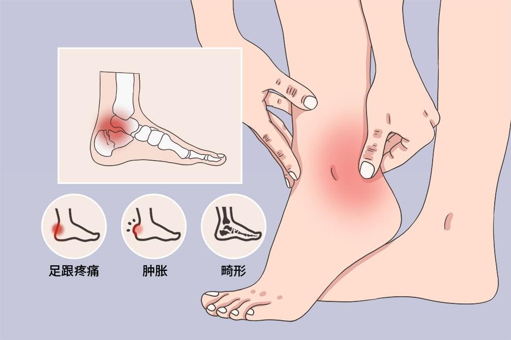 脚踝骨折60天康复锻炼