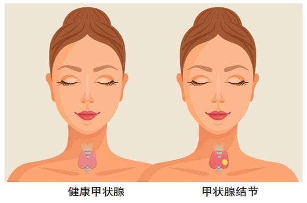 体检发现甲状腺结节钙化！会变成癌吗？该如何应对呢？