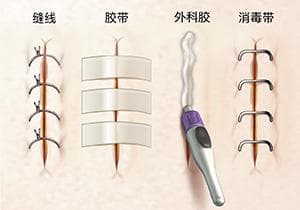 切口护理指南：从家庭护理到专业复诊的全方位指导