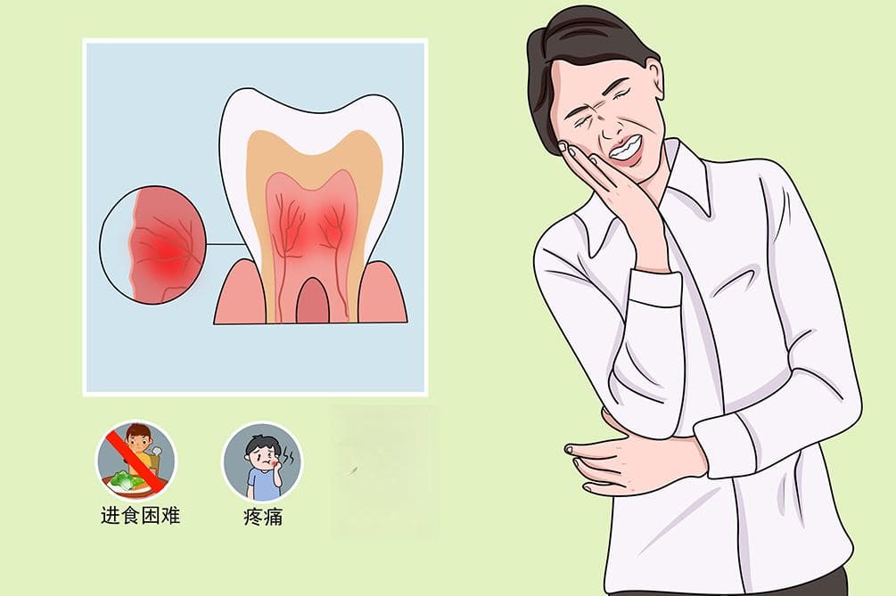 牙齿神经痛：症状、诊断与治疗全解析