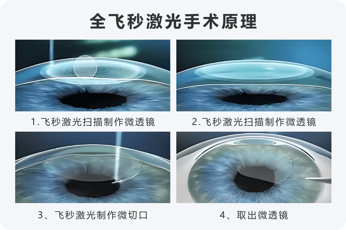 飞秒手术后注意事项全攻略