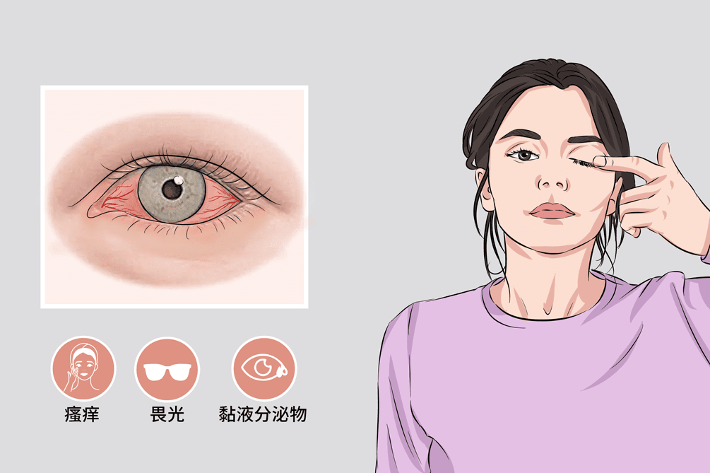 一夜接诊400例！医生提醒：别再自行买药，过敏性结膜炎这样治