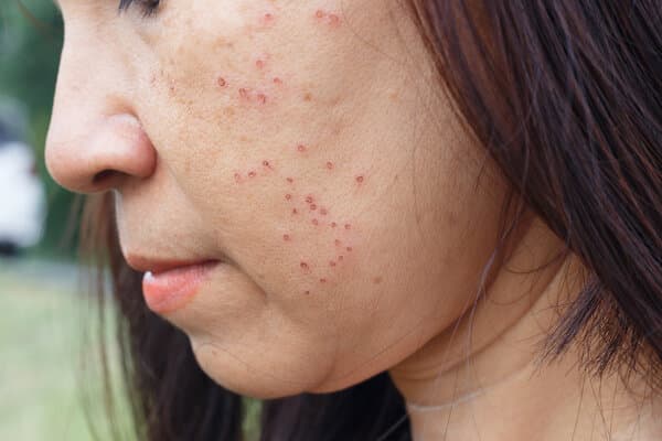 青春痘的治疗最佳方法
