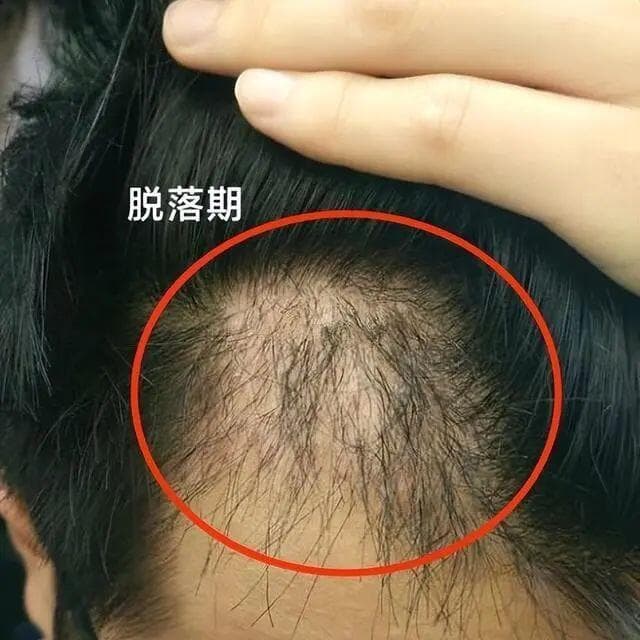 植发后牢记这6点，轻松度过植发脱落期！
