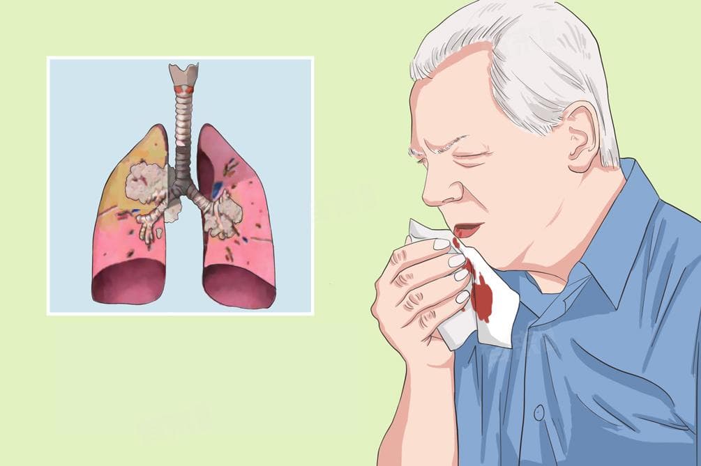 肺鳞癌的治疗方法主要有几种