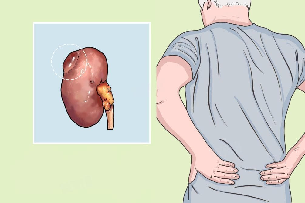 中医治肾囊肿最佳治疗方法