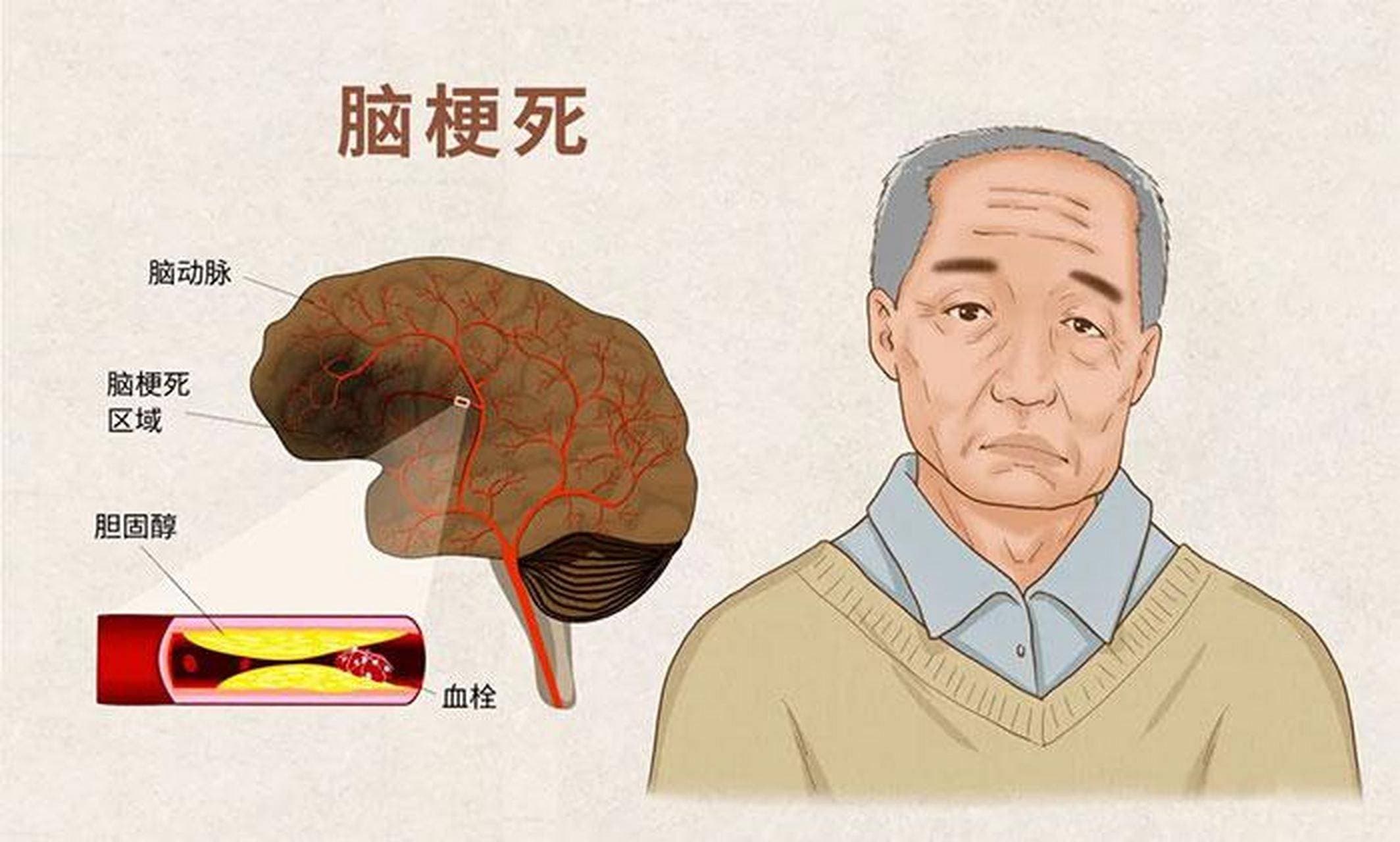 脑梗后遗症患者的水果指南：两类水果需谨慎食用