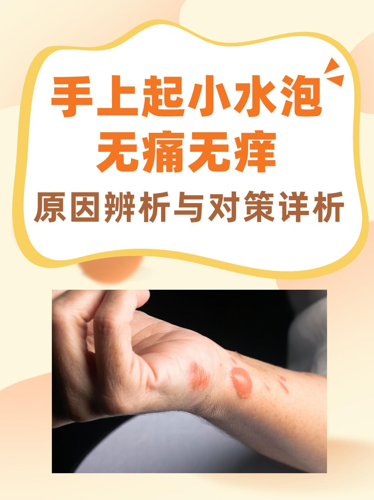 手上冒出小水泡？无痛痒，原因竟是这样