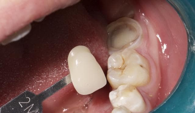 假牙使用不当会有哪些危害？如何正确佩戴和清洁假牙？