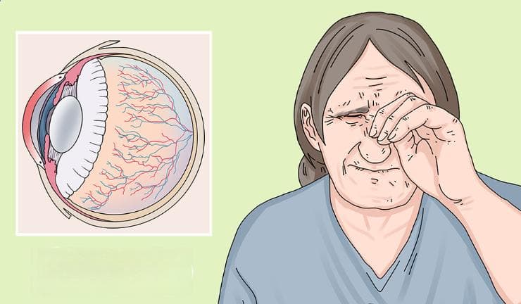 干眼症治疗指南：四种方法缓解眼部不适