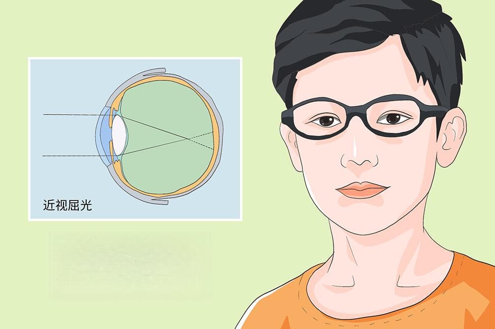 检查近视必须散瞳吗