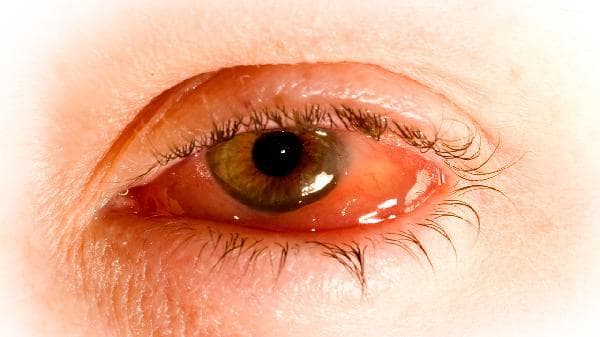 散瞳检查频繁的隐患：视力模糊与畏光如何影响眼健康？