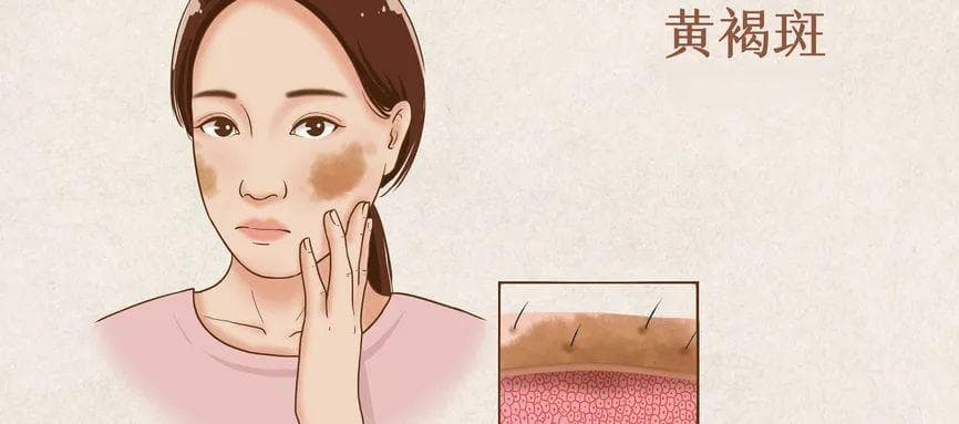 “走下神坛”的黄褐斑，并非无法治疗