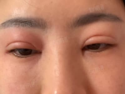 眼睛双眼皮肿了怎么办