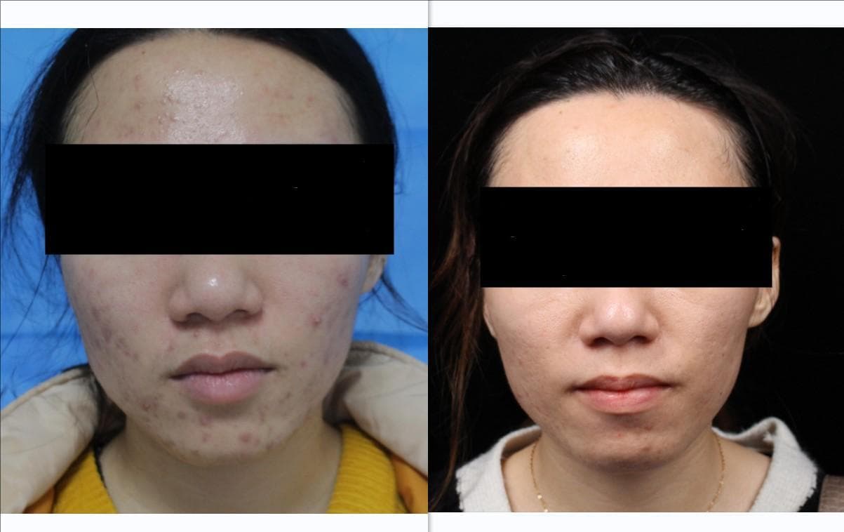 红蓝光为什么能治疗痘痘？