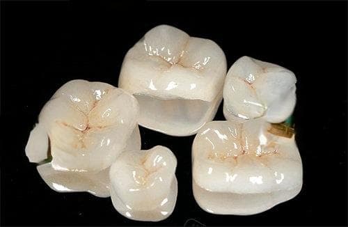 烤瓷牙使用寿命及更换建议：二十年的烤瓷牙是否需要更换？