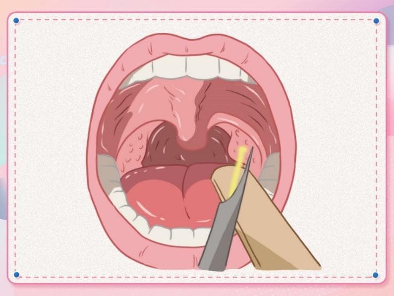 儿童腺样体肥大怎么办？这些中医方法值得一试！