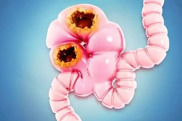 【全国肿瘤防治宣传周】结直肠癌术后常见的5类感染，该如何防治？一文教会你