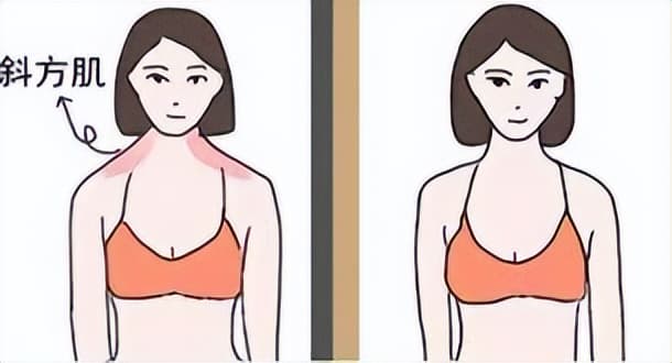溜肩，让人看起来头大脖子粗！肩膀溜了？原因和科学康复都在这里