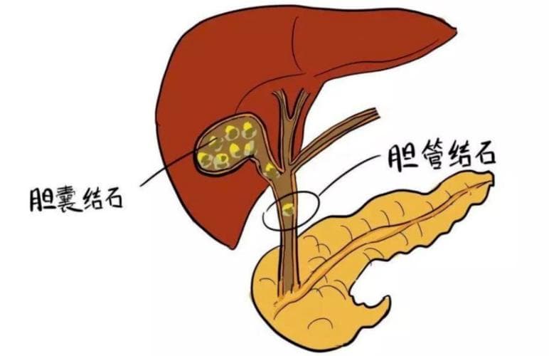 胆囊结石能否自行检查？