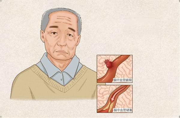 冬季高发的脑卒中，老年人该如何预防？