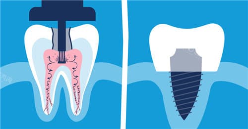 二次根管治疗好还是拔牙好？分析根管二次治疗成功概率、危害！