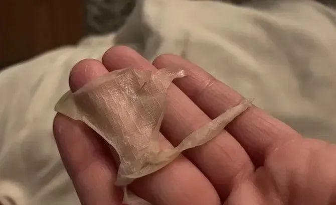 每一次洗完澡，就像脱了一层皮，看上去像被开水烫过一样，只因这种基因缺陷