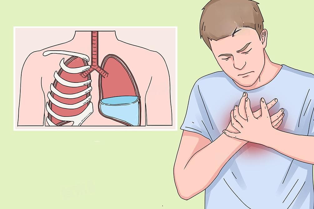 腔膜积液：成因、治疗与预后全解析