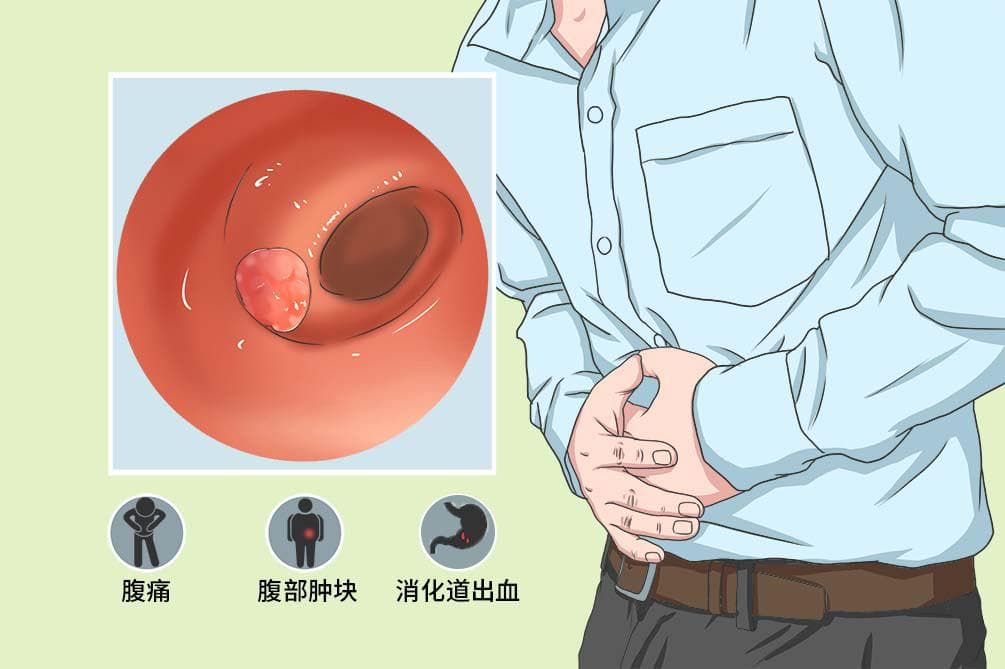 小肠平滑肌肉瘤