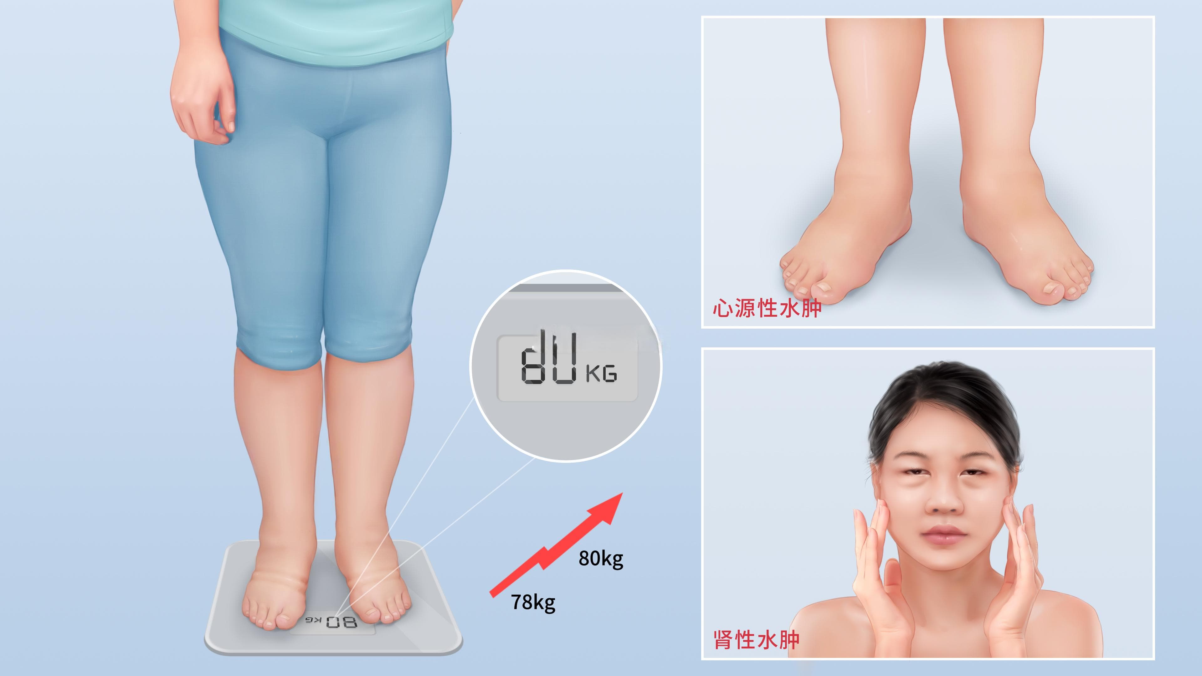 水肿：症状、类型及诊断指南