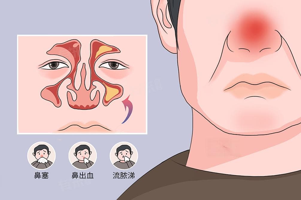 鼻渊是什么？中医眼中的“鼻窦炎”全解析