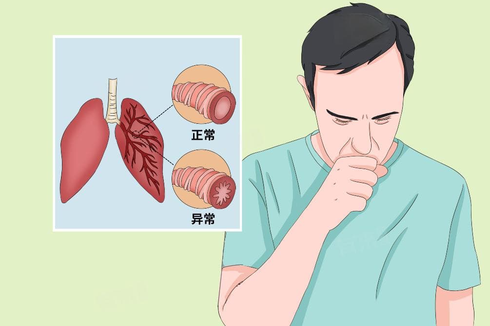 嗜酸性粒细胞支气管炎怎么治