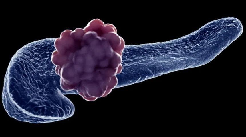 南京大学团队在转移性胰腺癌治疗领域取得重要突破