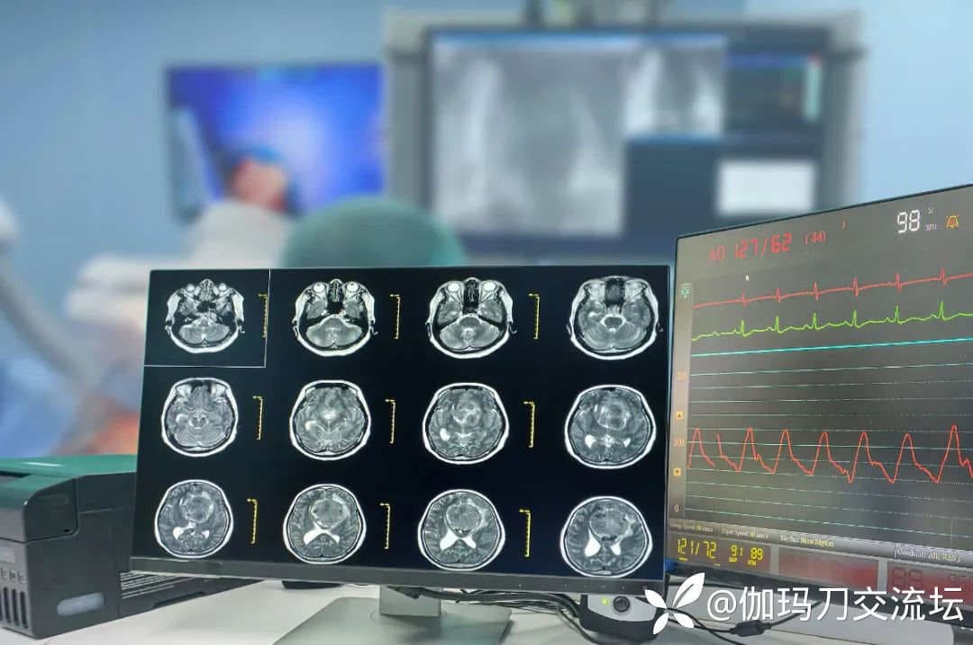 胶质母细胞瘤治疗突破：大分割放疗--科学探索下的生存希望！