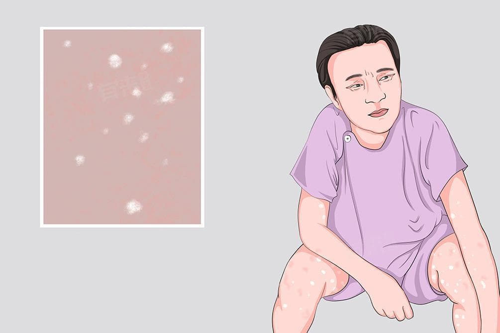 皮肤出现白点怎么办？可能的原因及处理方法