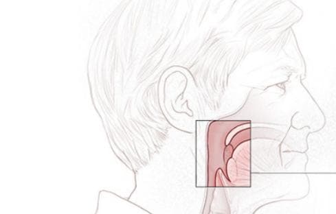 喉癌的病因、诊断方法及治疗方案