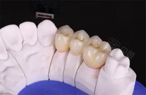 牙冠异物感强怎么办?合理建议大放送,解决牙冠不适的六大策略,让您重拾舒适笑容