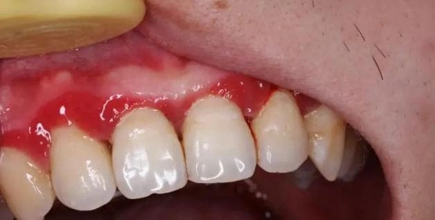 牙周炎：让牙齿容易脱落的隐形杀手