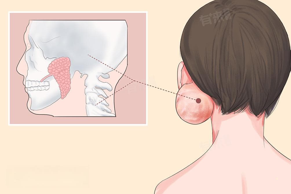 腮腺混合瘤是什么意思