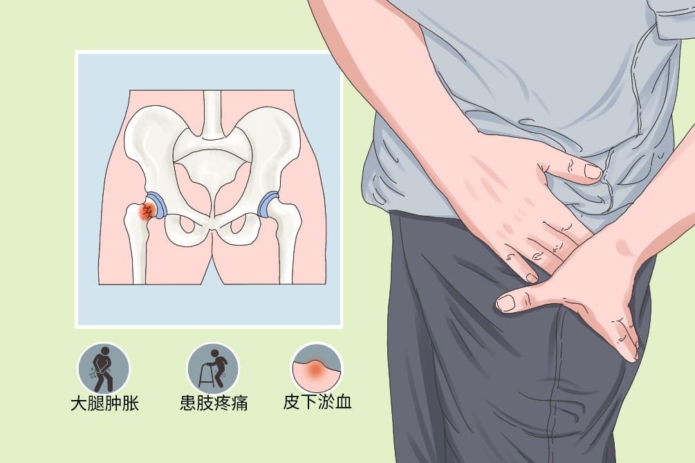 股骨粗隆间骨折