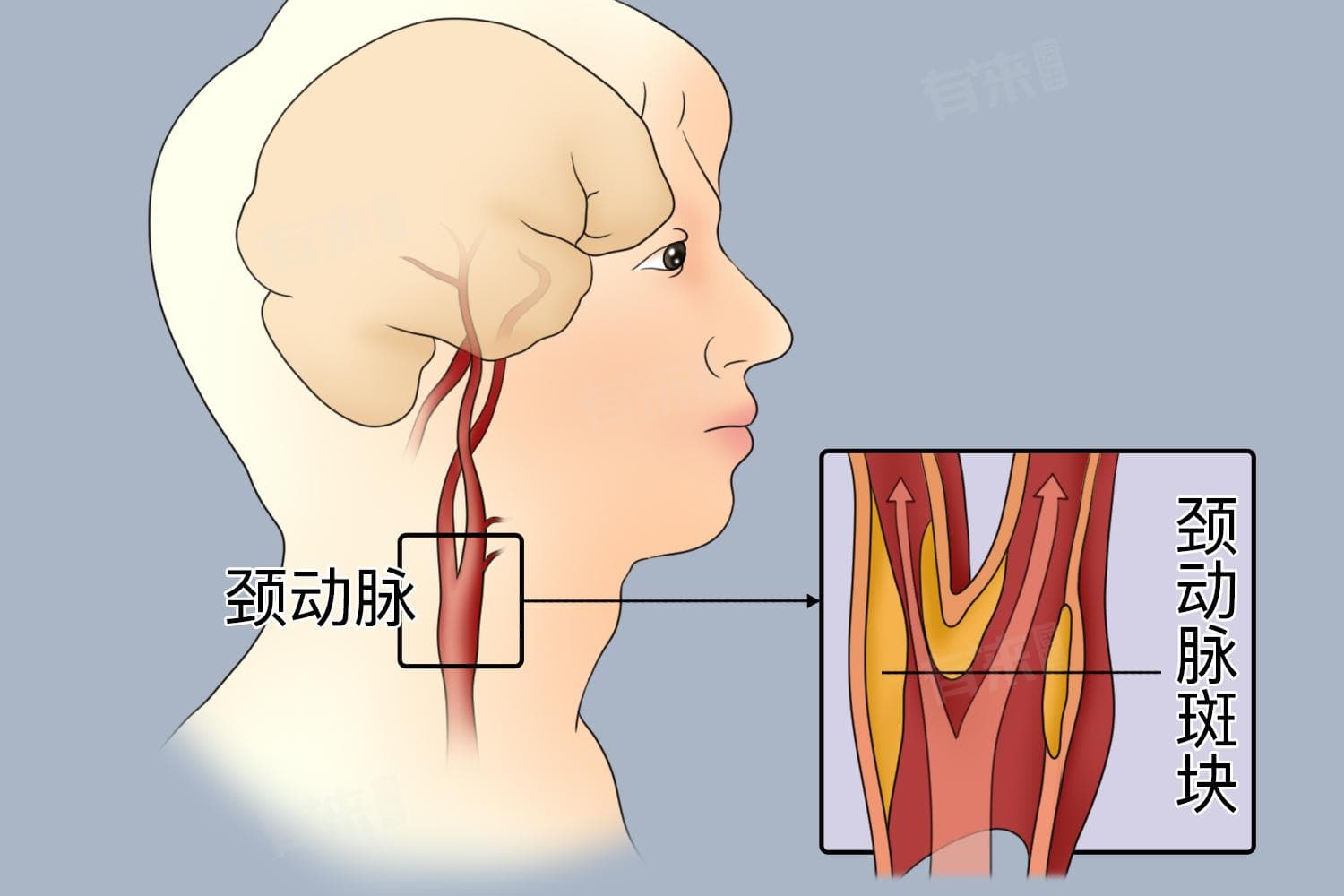 查颈动脉斑块挂什么科