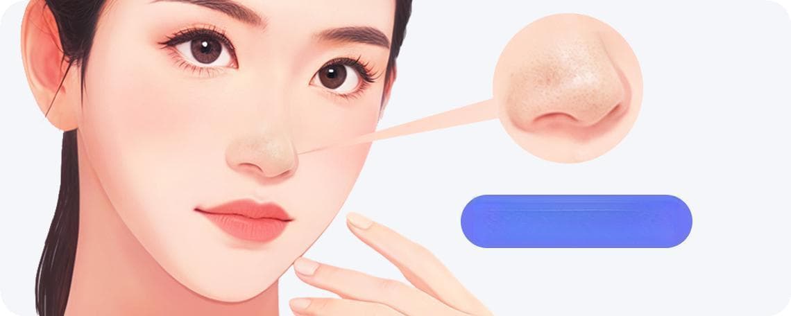 脂栓型黑头怎么去除